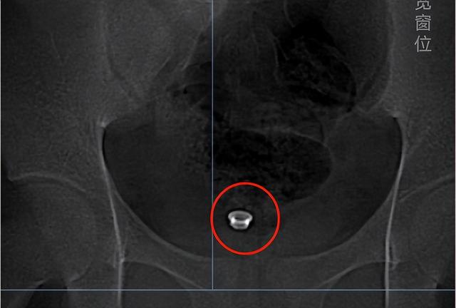 看着都疼！两名初中生“好奇”将20厘米胶棒和螺帽从尿道塞入膀胱