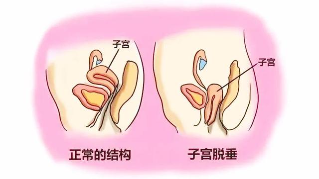 性生活时，女性私处总发出“噗噗”的放屁声？多半与5个原因有关