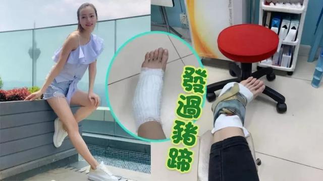 脚裸骨头移位！36岁前TVB小花脚崴仍出席活动：结果导致停工三周