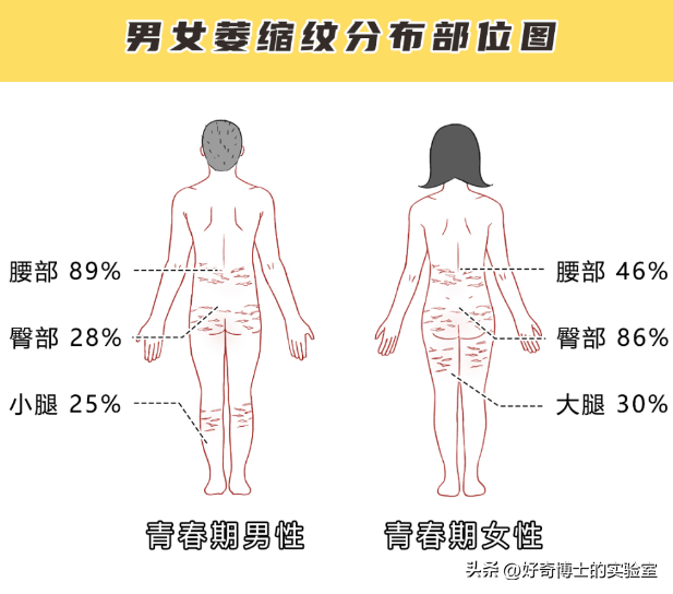 为啥很多女生大腿、屁股附近，会有白色条纹？