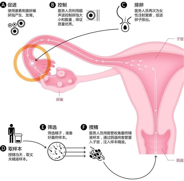 英国女子自己操作人工授精，一次成功！普通人千万不要尝试