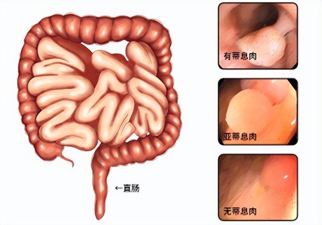 深圳一女子肛检后称被性侵，是肛诊的错？关于肛诊，一文告诉你