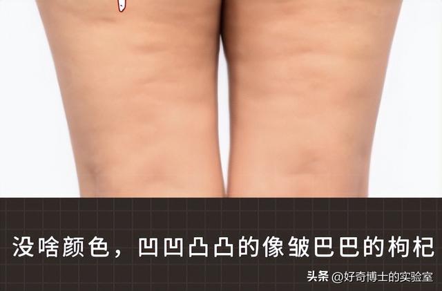 为啥很多女生大腿、屁股附近，会有白色条纹？