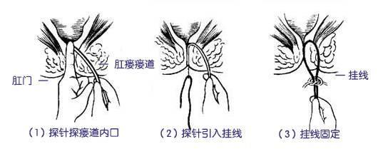 肛门附近长“痘”，女子拒绝就医！医生：小心痛不欲生