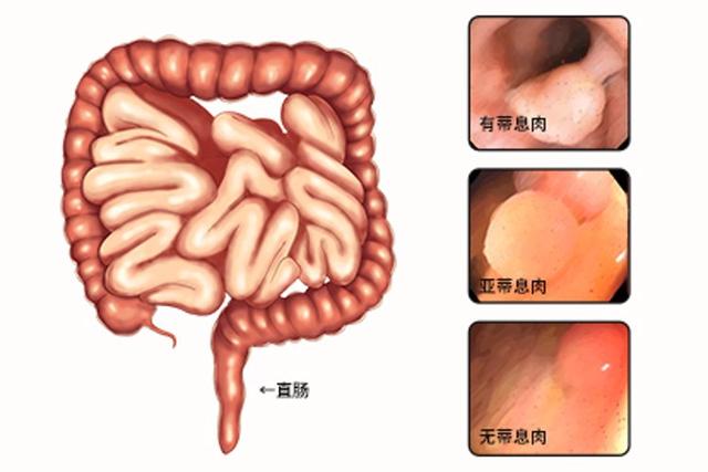 女子屁股痒，以为是痔疮强忍8年，做肠镜后，医生叹息：来得太晚