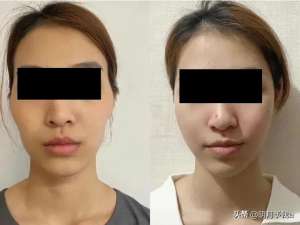 绑美女腿脚(女子过海关双腿绑满少女针，用裙子遮掩)