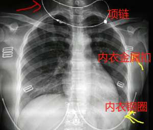 美女被拍胸罩(长沙美女体检拍胸片，要求脱内衣？医生这样解释)